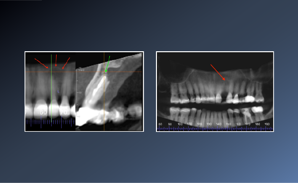 How to prevent an unnecessary extraction! – February 10,&hellip;