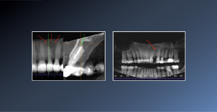 How to prevent an unnecessary extraction! – 10th Feb 2022