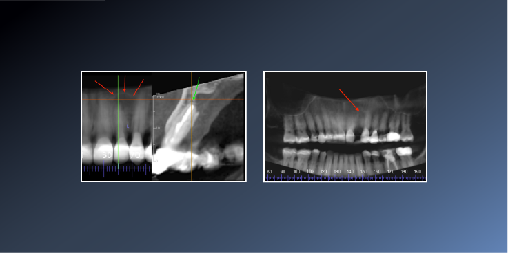 How to prevent an unnecessary extraction! – 10th Feb&hellip;