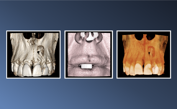 An Endodontic Radiolucency – December 08, 2022