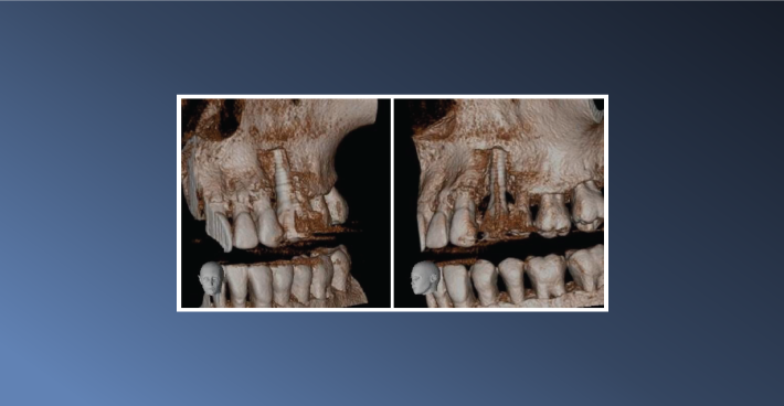 A Failed Implant Case – January 25, 2023