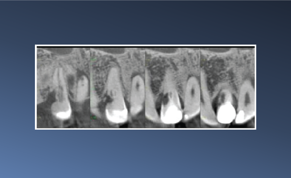 Bilateral Dens Invaginatus – March 20, 2023