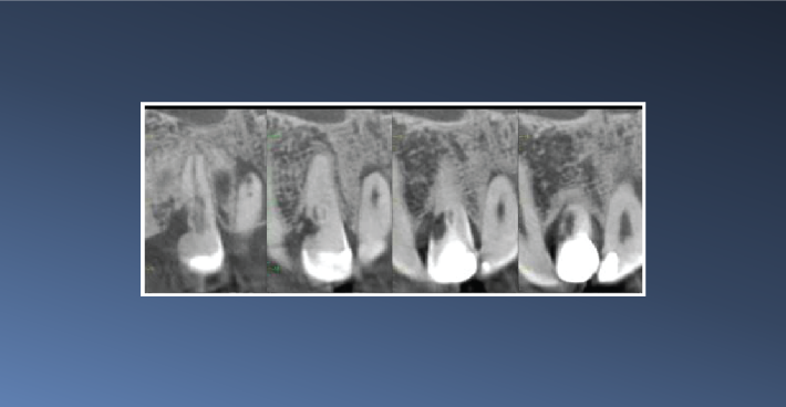 Bilateral Dens Invaginatus – March 20, 2023
