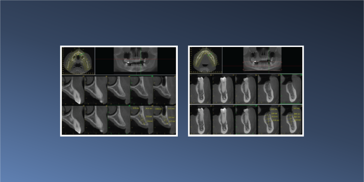 Implant Planning in Both Jaws – May 22, 2023
