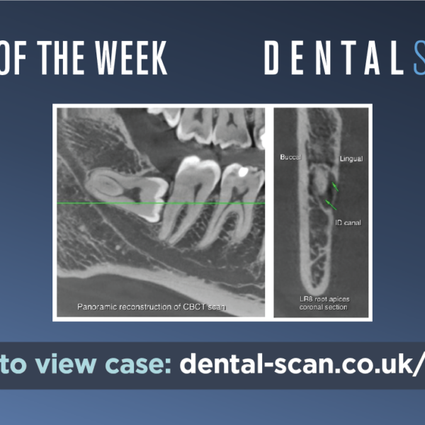 Impacted Lower Third Molar – June 27, 2023