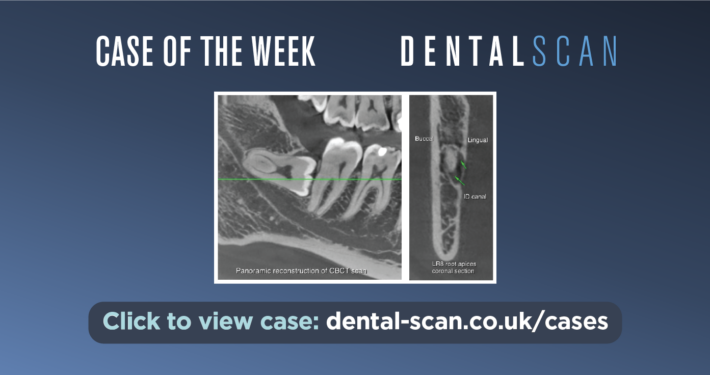 Impacted Lower Third Molar – June 27, 2023