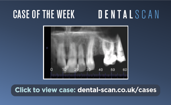 ???? Implant Planning – July 13, 2023