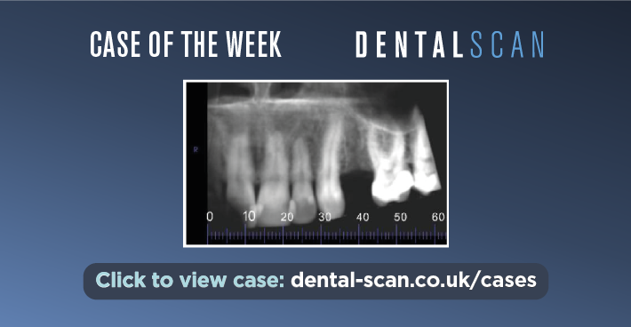 ???? Implant Planning – July 13, 2023