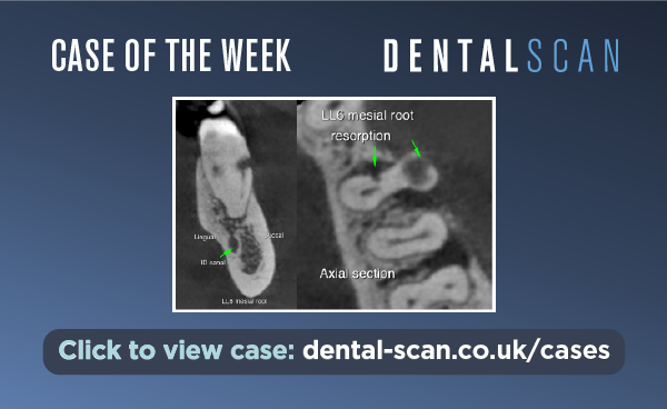 An Endo-Perio Lesion ???? – July 27, 2023
