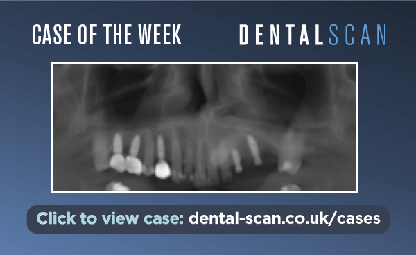 Case of the Week – Implant and Canine Collision