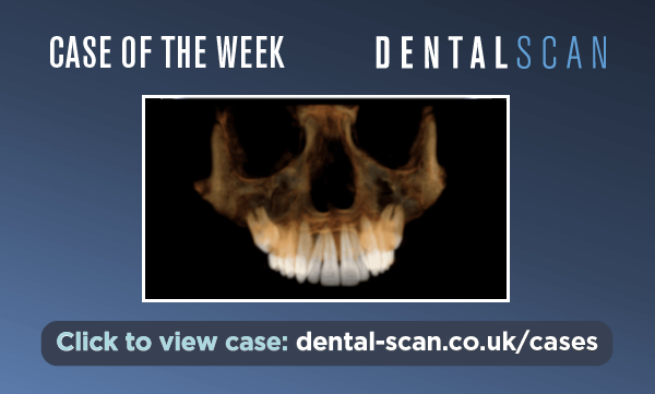Case of the Week -Bilateral Unerupted Upper 2nd and&hellip;