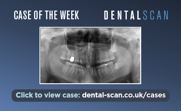 Case Of The Week – CBCT and Biopsy Advised – May 21,&hellip;