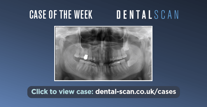 Case Of The Week – CBCT and Biopsy Advised – May 21, 2024