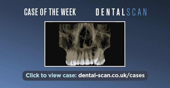 Case Of The Week – Johan Lermyte – Large anterior lesion – July 18, 2024