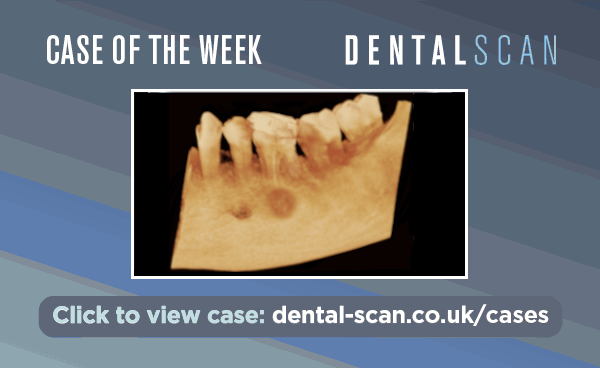 Case Of The Week – Hemicircular Bone Growth: Should You Be Concerned?