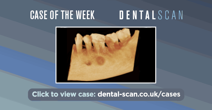Case Of The Week – Hemicircular Bone Growth: Should You Be Concerned?