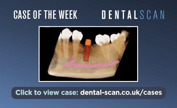 Case Of The Week – Place a Virtual Implant&hellip;