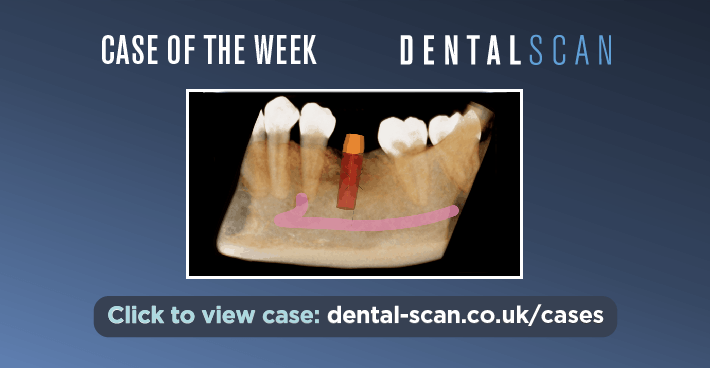 Case Of The Week – Place a Virtual Implant in 10 Sec!
