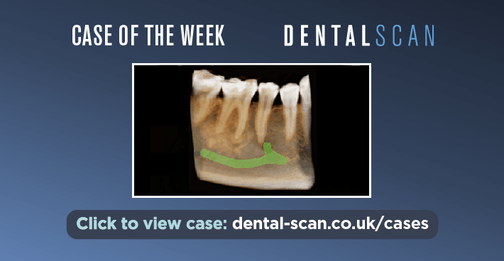 Case of the Week – A Focal Osseous Dysplasia