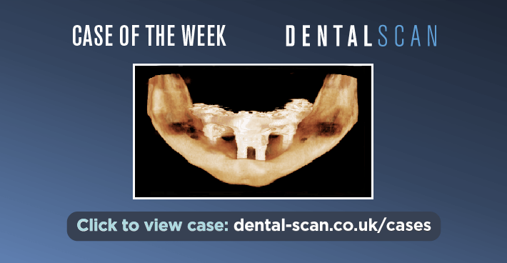 Case of the Week – A Fractured Mandible