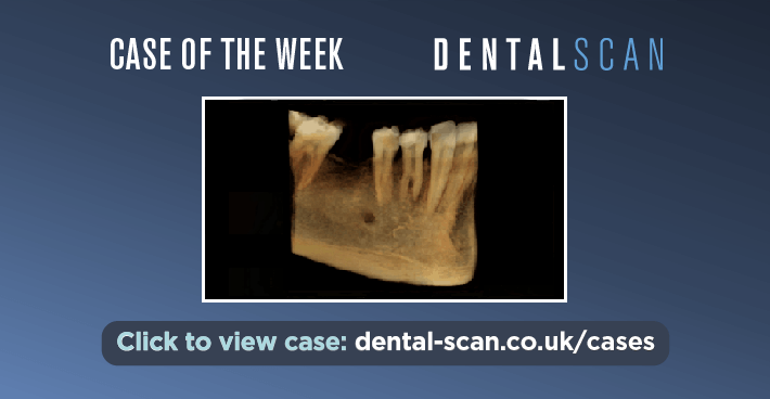 Case of the Week – Trifid Roots on a Premolar