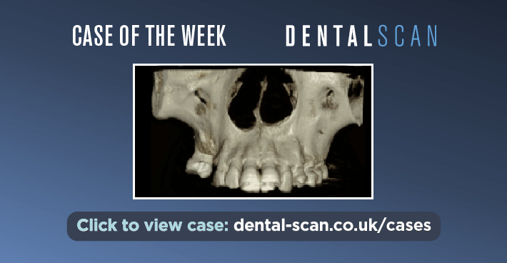 Case of the Week: Unexpected Mass Identified During Routine Implant CBCT
