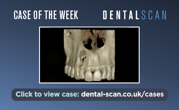 Case of the Week – Periapical Lesion of Pulpal&hellip;