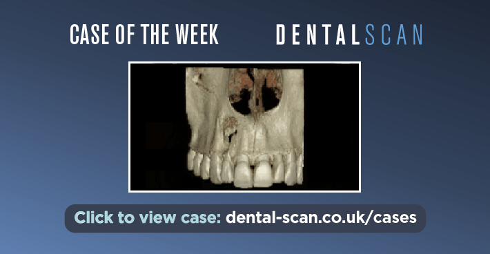 Case of the Week – Periapical Lesion of Pulpal Origin