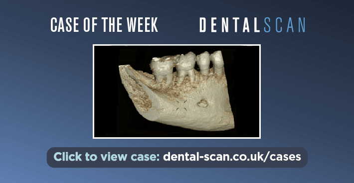 Case of the Week – A Periosteal Bone Reaction